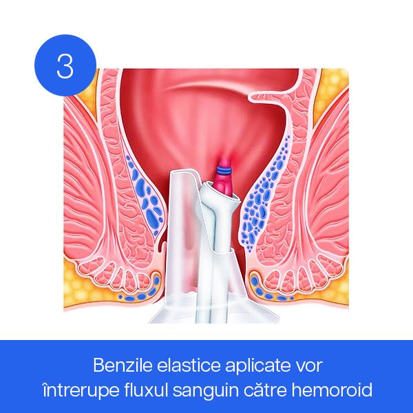 Benzile elastice aplicate vor întrerupe fluxul sanguin către hemoroid