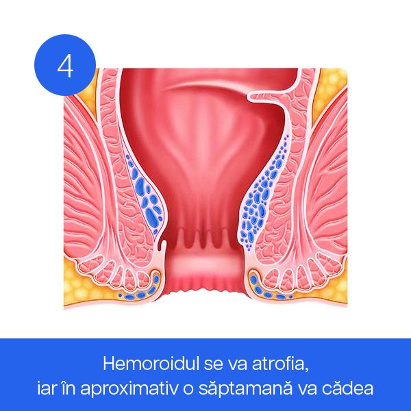 Hemoroidul se va atrofia, iar în aproximativ o săptămână va cădea